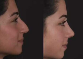 H Rhinoplasty 7 (1)