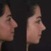 H Rhinoplasty 7 (1)