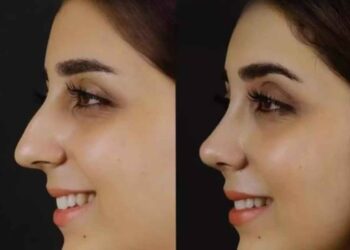 H Rhinoplasty4 copy 11zon (2) 11zon