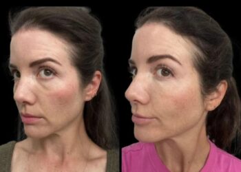 Dark Circles Treatment in Dubai: Safe and Effective Methods for Busy Professionals