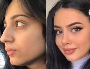 Rhinoplasty in Dubai Rhinoplasty in Dubai