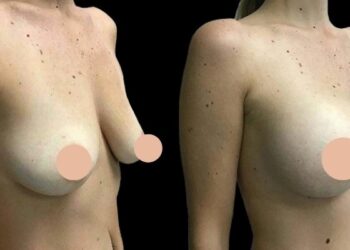 Step-by-Step Journey of Breast Augmentation in Dubai