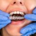 invisalign Crawley