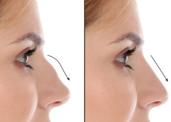 Septoplasty in dubai