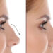 Septoplasty in dubai