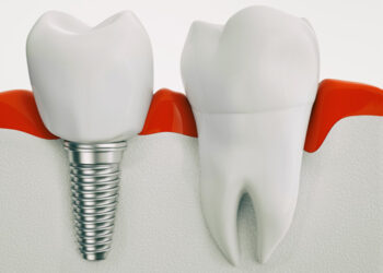 ZahnarztInGörllitz Implantologie