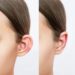 ear reshaping in islamabad