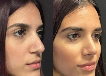 nose surgery in dubai