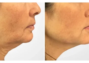 Thread Lift by Best Plastic Surgeons in Dubai: Achieve Youthful, Radiant Skin Naturally