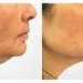 Thread Lift by Best Plastic Surgeons in Dubai: Achieve Youthful, Radiant Skin Naturally